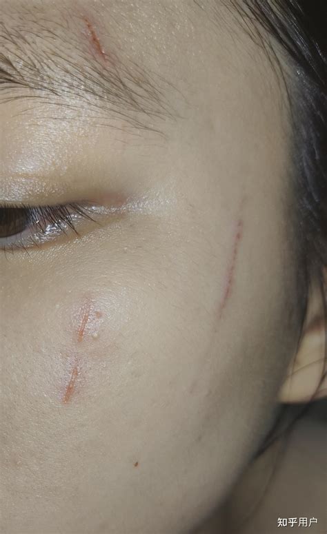 脸被猫抓伤，如何护理不会落疤或印痕？ - 知乎