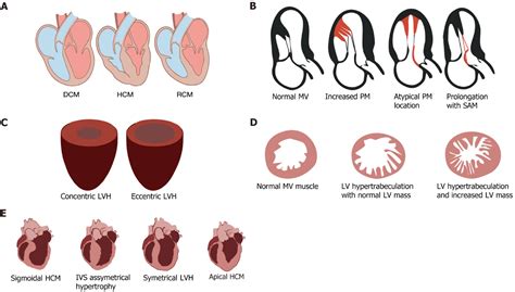 Non Compaction Cardiomyopathy