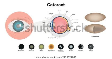 Vision Disorder 的图像结果
