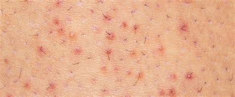 What Does Folliculitis Look Like