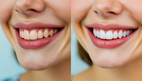 Professional Teeth Whitening: Before And After Expectations - fashionabc