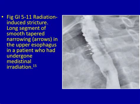 5 esophageal narrowing | PPTX