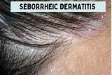Seborrheic Dermatitis: Symptoms, Causes Treatments, 58% OFF