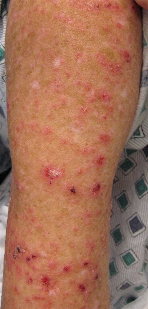 Red Bumps On Arm From Sun at Lucinda Mccathie blog