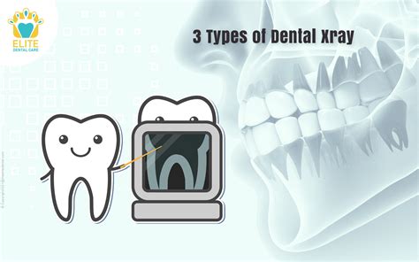 Types Of X Rays In Dentistry at Donte Galiano blog