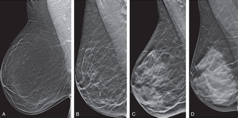 Why BI-RADS?: Overview of Breast Imaging Reporting and Data System (BI-RADS) - Clinical Tree