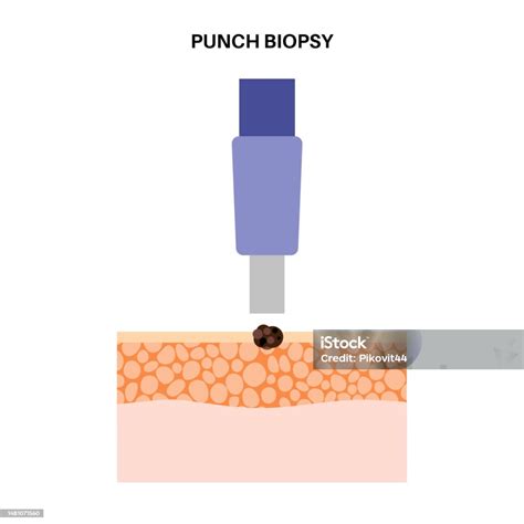 Punch Biopsy Procedure Nhs at Hector Myers blog