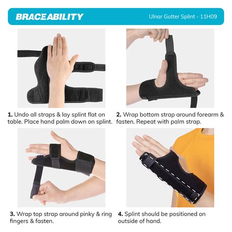 When To Use Ulnar Gutter Splint at Kristie Cummings blog