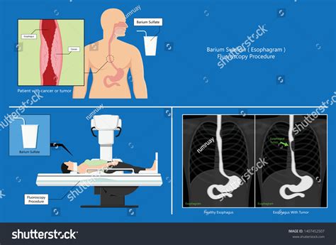 Barium Swallow Study Test Diagnose Barretts Stock Vector (Royalty Free) 1407452507 | Shutterstock