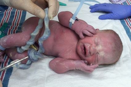 Bildergebnis für umbilical cord wrapped around neck