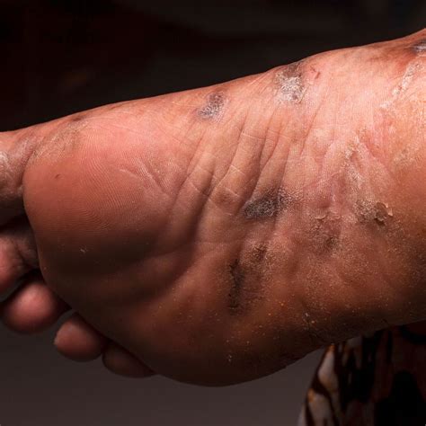 Skin of Color im Praxisalltag - Dermatologie - Universimed - Knowledge ...