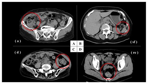 Correlation between Constipation Symptoms and Abdominal CT Imaging: A Cross-Sectional Pilot Study