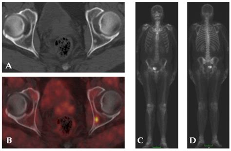 Emerging Role of Nuclear Medicine in Prostate Cancer: Current State and ...