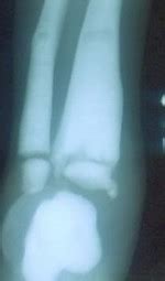 Grand Rounds and Teaching Files - HIV in Children