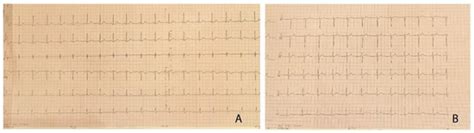 Implantation of Covered Stent for Coarctation of the Aorta and ...