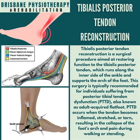 Posterior Tibial Tendonitis Exercises