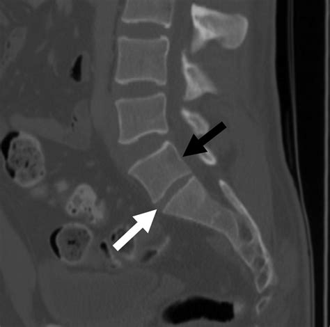 Vertebras Preventive Vertebroplasty For Adjacent Vertebral Bodies: A