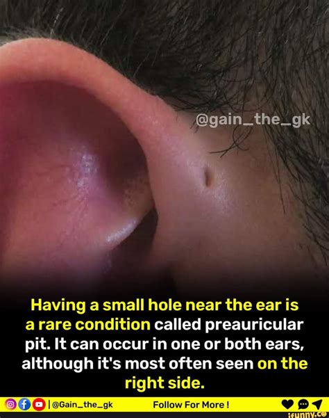 Having a small hole near the ear is a rare condition called preauricular pit. It can occur in ...