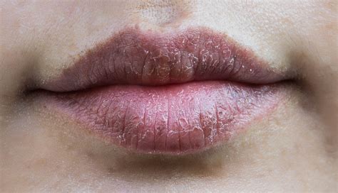 8 DIY Ways To Treat Dry Lips in Winters - lifeberrys.com
