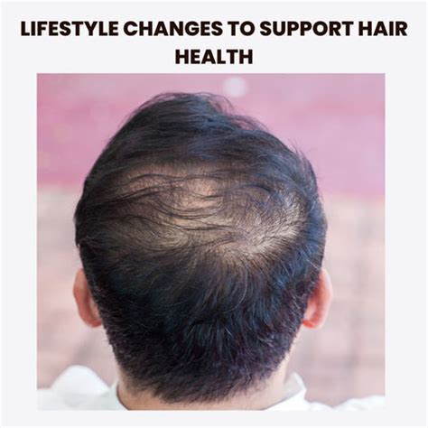 Steroids and Hair Loss: Understanding the Connection | Clinikally