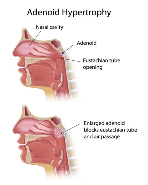 Enlarged Adenoids Face