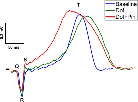 Repolarization Of The Heart