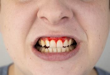 Laser Gum Treatment in Pragathi Nagar, Kukatpally | DermaDent