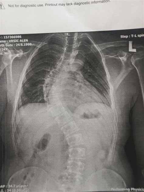 Before and after my t4 to l1 fusion. Thoracic 65 and 39 lumbar curve. : r/scoliosis