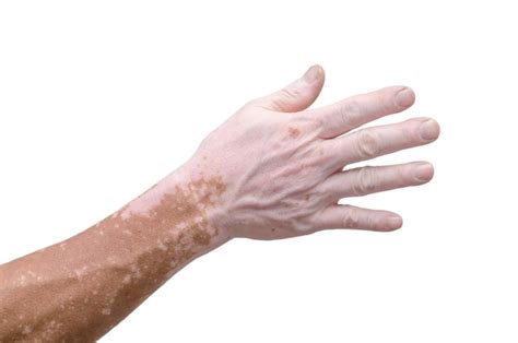 Vitiligo - Diagnóstico y Tratamientos - Dermatología Dexeus