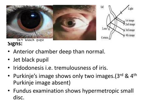 Pseudophakia Of Both Eyes
