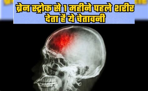 Brain Stroke से एक महीने पहले हमारा शरीर देता है ये चेतावनी, एक्सपर्ट ...