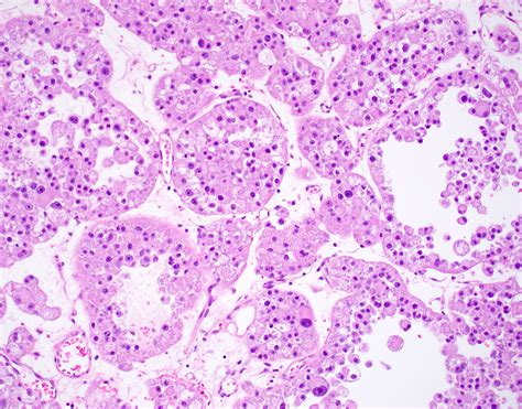 Pathology Outlines - Alveolar soft part sarcoma