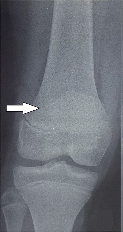 Avulsion tibial tubercle fracture, resulting from a low energy trauma - Reibs - Ινστιτούτο ...