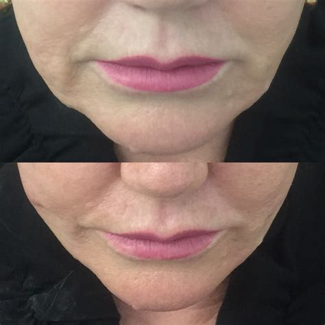 Non-surgical Jowl Lift | Thread Lift, HIFU, Injectables & Fillers for Jowl