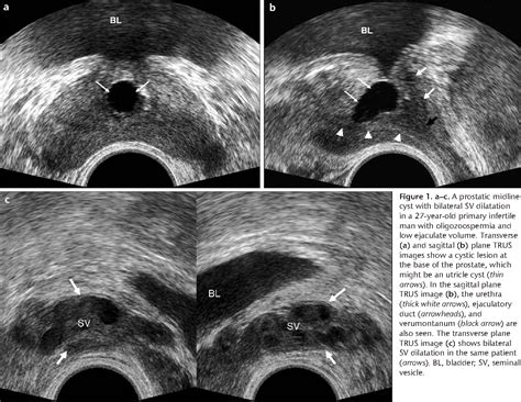 Figure 8 from Transrectal US-guided seminal vesicle aspiration in the ...