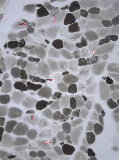 Muscle weakness: Understanding the principles of myopathy and ...