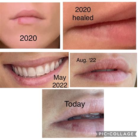 2020 cold sore left scar, now dark mark appearing over time? : r/Dermatology