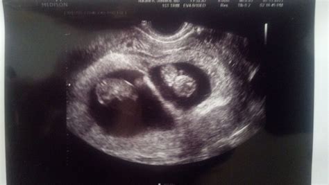 7 Week Ultrasound Fraternal Twins