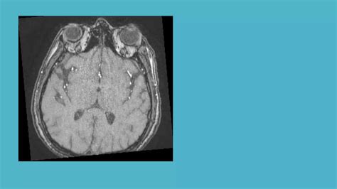 Magnetic Resonance Angiography and Venography | PPTX