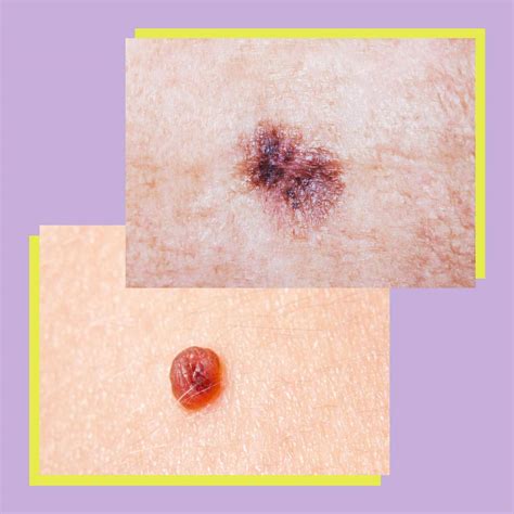 What Does Melanoma Look Like?