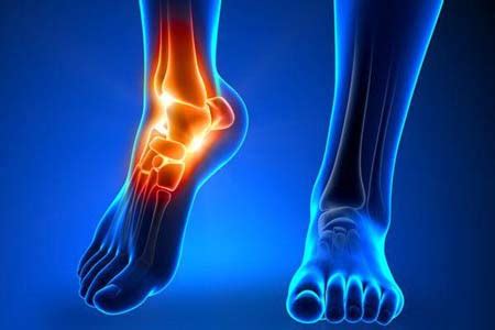 Ankle Replacement Surgery in India, Surgeon, Hospital, Cost