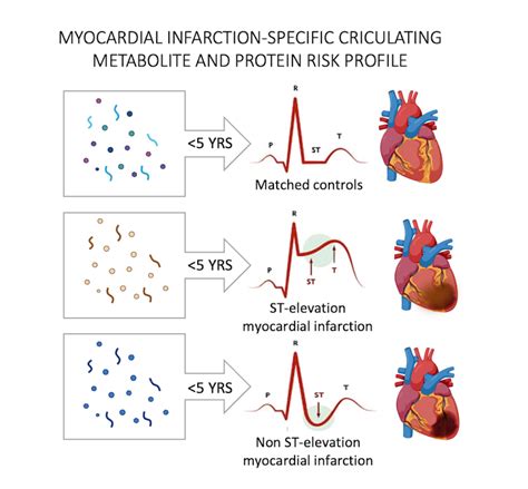 Non St Elevation Myocardial Infarction