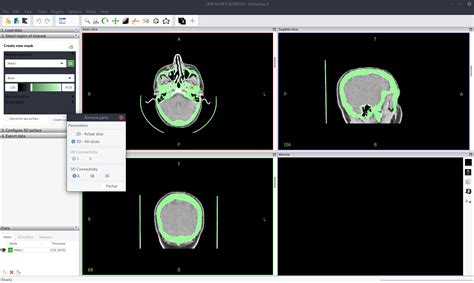 InVesalius Tutorial 的图像结果