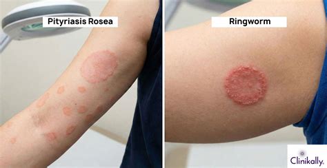 How to Tell if Your Rash is Pityriasis Rosea or Ringworm | Clinikally