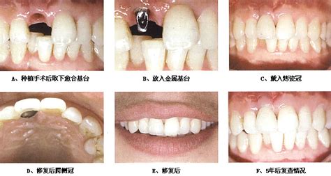 种牙韩国和美国的区别有3个比较明显，选种植牙前要留意！-非常爱美