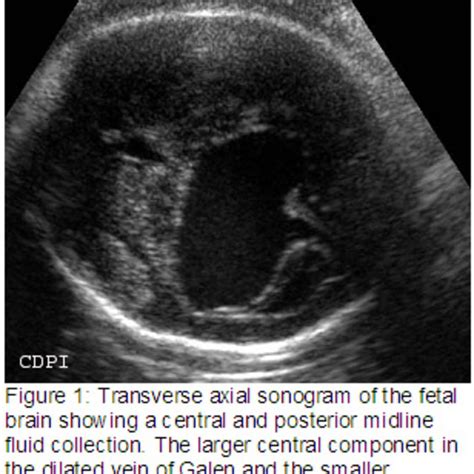 📃 Vein of Galen aneurysm