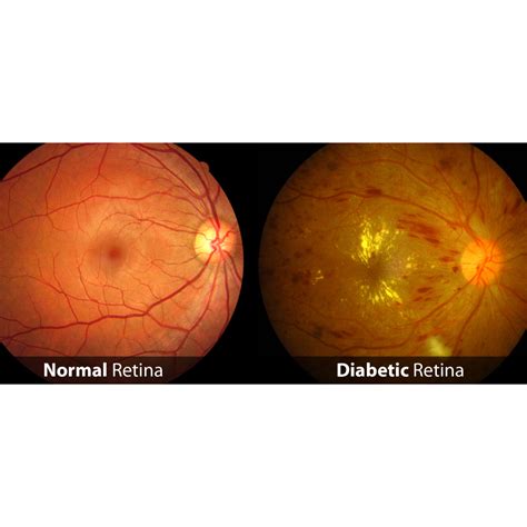 Retina disease - Sonovision Hospital