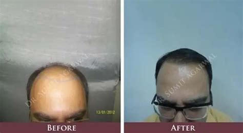 Precautions To Take Before Hair Transplant Surgery