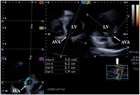 Does Left Ventricular Rotational Mechanics Depend on Aortic Valve ...