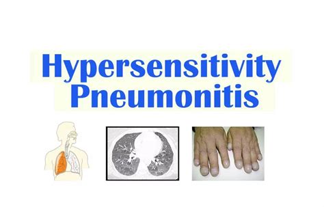 Diagnosis and management of hypersensitivity pneumonitis: Chest guidelines